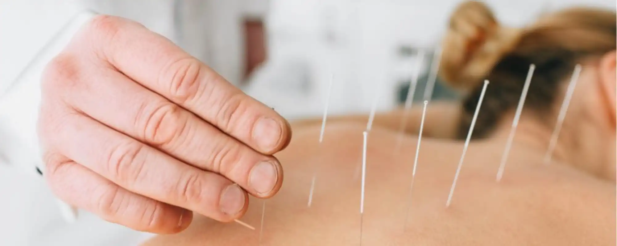 Dry-Needling